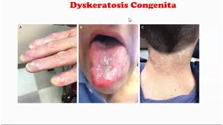 Dyskeratosis Congenita [upl. by Mairam]