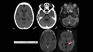 Case 102 A 7yearold male patient presenting with pyrexia earache and a single seizure [upl. by Dearman]