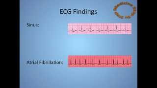 Atrial Fibrillation  AF [upl. by Ssilem]