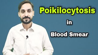 Poikilocytosis  Types of Poikilocytosis  4th Video  Blood Smear Series [upl. by Annael]