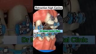 How to fix high canine teeth with bracesdental viral orthodontist youtubeshorts shorts trendi [upl. by Ynohtona]