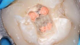 Obturation of Root Canal in Lower Molar amp live demo [upl. by Voss781]