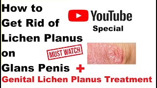 How to Get Rid of Lichen Planus on Glans Penis amp Genital Lichen Planus  a Proven Home Treatment [upl. by Kirbee]