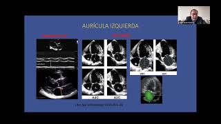 Ecocardiografia en la predicción de embolismo y recurrencia de la FA  Carlos Javier Ramirez [upl. by Arst]