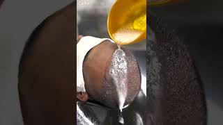 Expert Tips for First Shampoo After Hair Transplant  Cara Clinic [upl. by Aynuat]