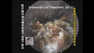 An exception of cholesteatoma in the ear canal and the ears of an elderly and child 20231012 [upl. by Chancellor]