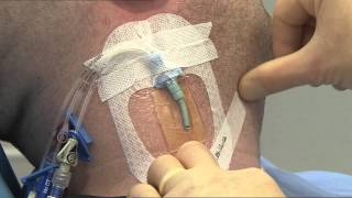 3M™ Tegaderm™ CHG IV Dressing 1657R Application and Removal Video CVC [upl. by Timrek79]