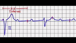 Cardiac Pacing Failure to CaptureFailure to Sense [upl. by Crifasi]