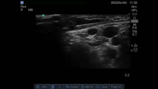 ultrasound guided Intercostobrachial nerve block [upl. by Anahsor]