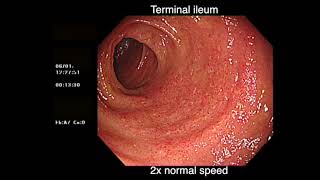 DEEP BACKWASH ILEITIS AND ULCERATIVE COLITIS [upl. by Conti]