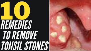 How To Remove Tonsil Stones Naturally 10 Home Remedies That Work [upl. by Rebm2]