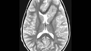 Cortical Dysplasia [upl. by Ahtiek280]