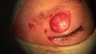 Molluscum Contagiosum Lesions Excision [upl. by Atiragram]