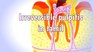 Irreversible pulpitis in tamilpulpitisflowerpot1564 [upl. by Ginni724]