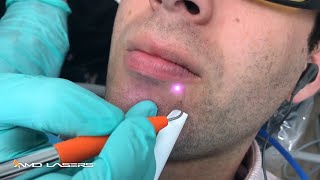 Herpetic Lesion Treatment [upl. by Lovich]