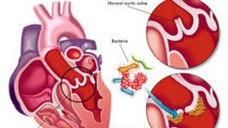 اقوى شرح Endocarditis بالتفصيل 💗🥰💫💯 [upl. by Dolhenty]