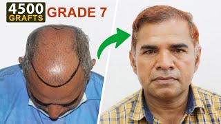 LifeChanging Hair Transplant Results 4500 Grafts  Dr Suneet Soni  Grade 7 Baldness  Medispa [upl. by Shaylynn]