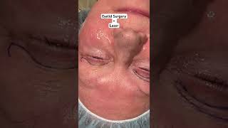 Upper Blepharoplasty  Under Eye Resurfacing Laser [upl. by Nimajneb]