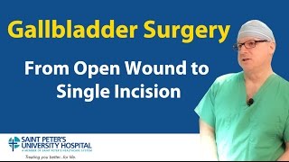 Gallbladder Surgery From Open Wound to Single Incision [upl. by Odnalra245]