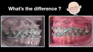 Use of Elastics and Space Generation in Midline Correction｜【Chris Chang Ortho】CC489 [upl. by Annaeel553]