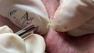 ACNE UNDER THE SKIN  Acne Treatment Mai Ngoc [upl. by Otreblasiul]