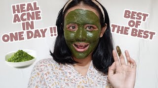 5 DAYS MATCHA GREEN TEA MASK ON ACNE PRONE SKIN  English [upl. by Clarence]