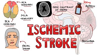 Acute Ischemic Stroke  Signs and Symptoms Stroke Syndromes  Causes amp Mechanisms  Treatment [upl. by Eatnahs708]