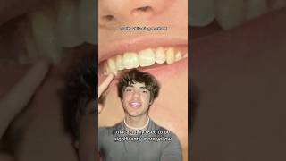 Dentist Reveals SHOCKING Teeth Whitening Secret 🤫🦷 [upl. by Anihpesoj454]