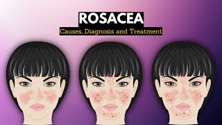 Rosacea Causes Signs and Symptoms Diagnosis and Treatment [upl. by Eeryn]