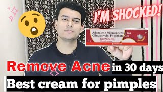 Adapalene Gel Review हिंदी में  How much effective it is for Acne amp Pimples  Deriva CMS Gel [upl. by Lorn]