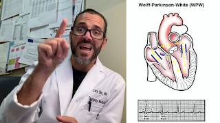 Wolff Parkinson White Syndrome  Patient Education [upl. by Arvonio]