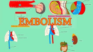 Pathology 18HDD 4  EMBOLISM  Pulmonary thromboembolism  Systemic thromboembolism AfSoomaali [upl. by Suirauqed]