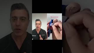 Bunion Corrector Does it works [upl. by Arbas]