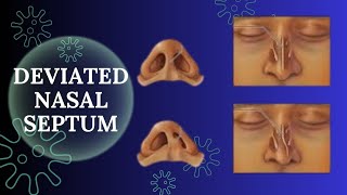 Best Treatment for Deviated Nasal Septum  ناک کی ہڈی ٹیڑھی ہونا  Dr  Tahir Aziz Zafar [upl. by Royce]