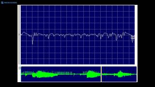 Kimura amp Kohara F12 Myotonic discharge recorded in clinically unaffected muscle [upl. by Lammond]