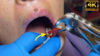 Abscessed Tooth Extraction in 1 MIN or less in 4K [upl. by Eceela]