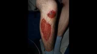 Leg Abrasion Healing Process [upl. by Gredel]