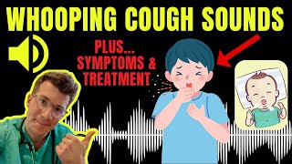 Doctor explains WHOOPING COUGH plus examples of REAL SOUNDS  Symptoms diagnosis treatment amp more [upl. by Ereveniug]