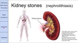 Kidney stones nephrolithiasis [upl. by Nire]