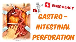 Gastrointestinal Perforation [upl. by Annnora174]