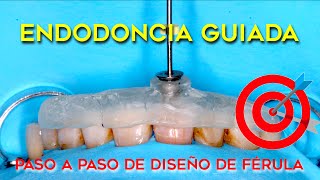 TUTORIAL ENDODONCIA GUIADA DIGITAL  CÓMO DISEÑAR LA FÉRULA PASO A PASO EN DIENTES CALCIFICADOS [upl. by Albrecht]