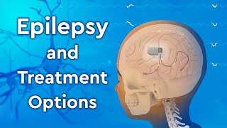 What is Epilepsy and How is it Treated [upl. by Reamy]