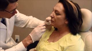 Patient Receives Juvederm Ultra Plus XC Treatment [upl. by Mariejeanne583]