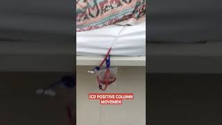 ICD POSITIVE COLUMN MOVEMENT PNEUMO HAEMOTHORAX [upl. by Akemal]