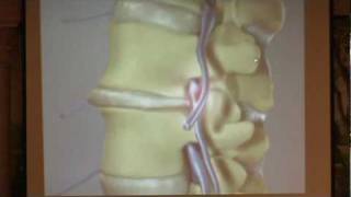 Lumbar Spinal Stenosis Part 2  Treatment Options Paul Houle MD [upl. by Anelhtak]