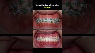 Underbite braces transformation braces orthodontist dentist bracket [upl. by Aicen]