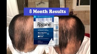 Does Rogaine REALLY Work 8 Month RESULTS  MENS ROGAINE 5 Minoxidil Hair Regrowth Treatment [upl. by Bevan]