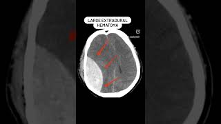 Extradural hematoma CT brain shorts viral shortsvideo [upl. by Sadnak]