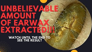 UNBELIEVABLE Amount Of Earwax Extracted From This Ear Watch Until The End [upl. by Ahsoyek525]