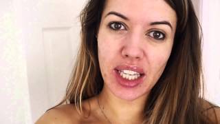 Daily Vlog  Back on Roaccutane 30mg  Month One  Super Gorgeous Blog [upl. by Rochette]